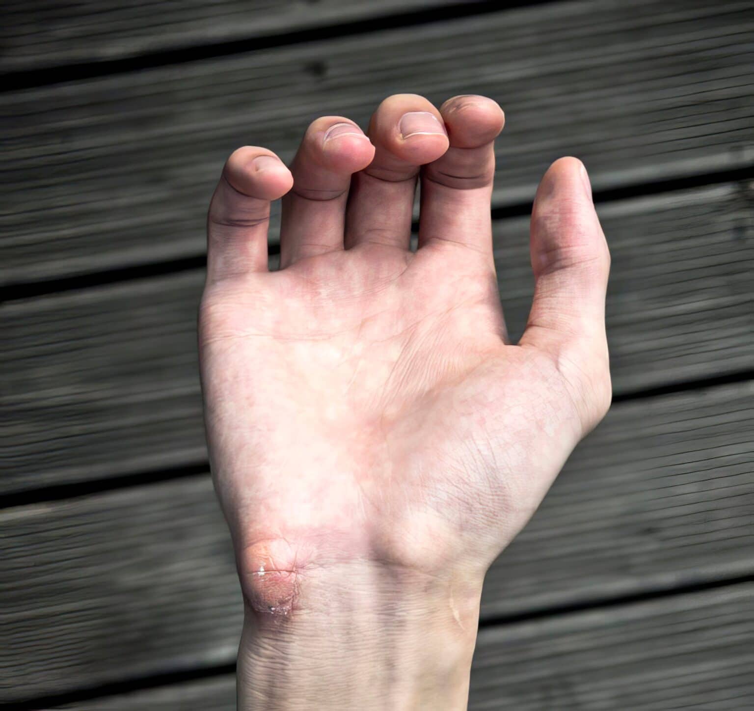 Understanding And Managing Gamer Callus: Causes, Symptoms, And ...